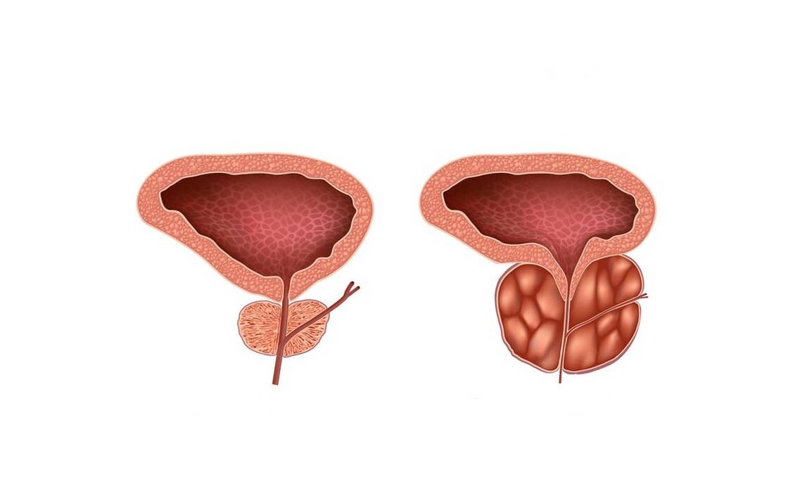 Simptomat e prostatitit tek meshkujt