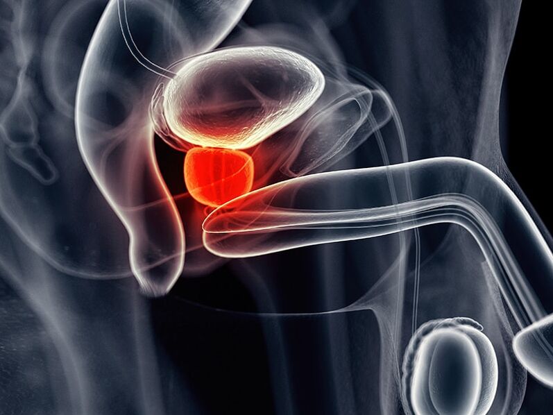 Inflamacion i gjëndrës së prostatës që shoqëron prostatitin kronik