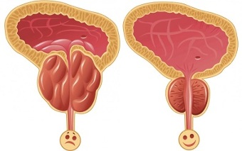 si nuk ProstEro prostatitis para dhe pas trajtimit